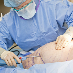 consideringliposuction consideringliposuction