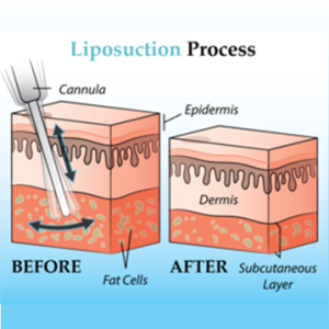 liposuction-procedure liposuction procedure