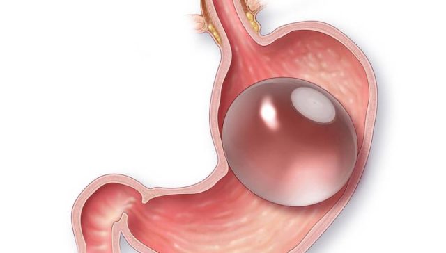 بالون المعدة