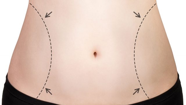 شفط دهون البطن للنساء