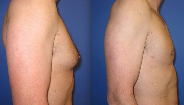 ازالة التثدي عند الرجال بالفيزر