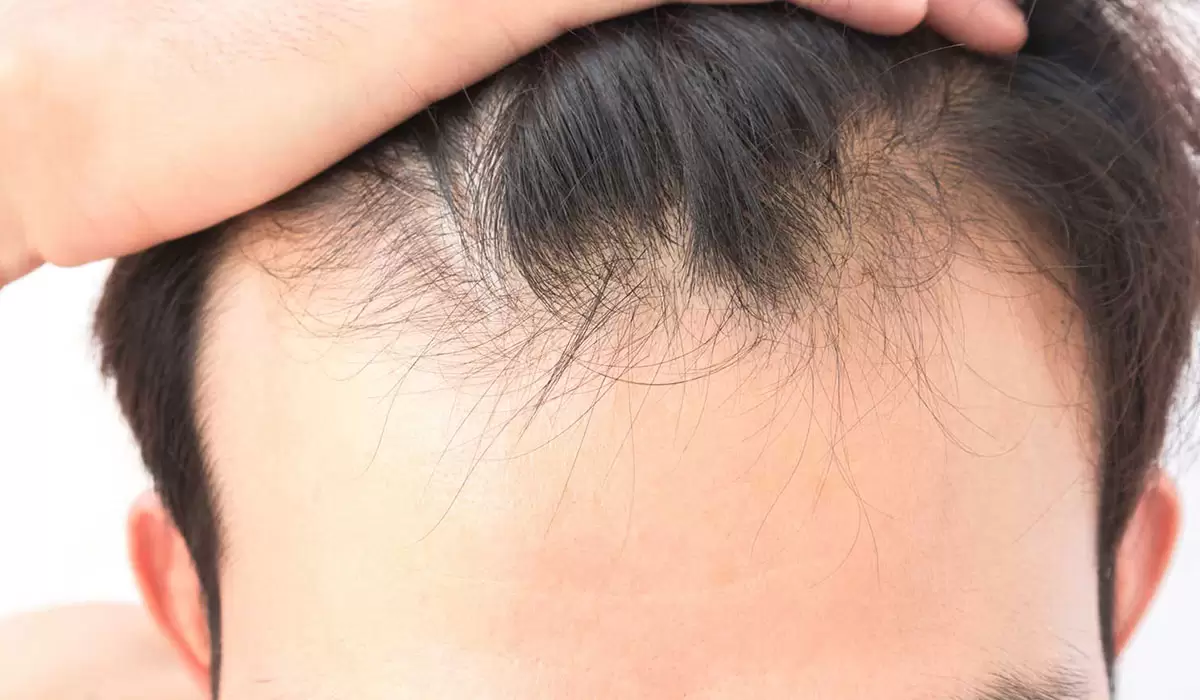 اسباب تساقط الشعر عند الرجال
