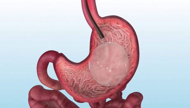 بالون المعدة