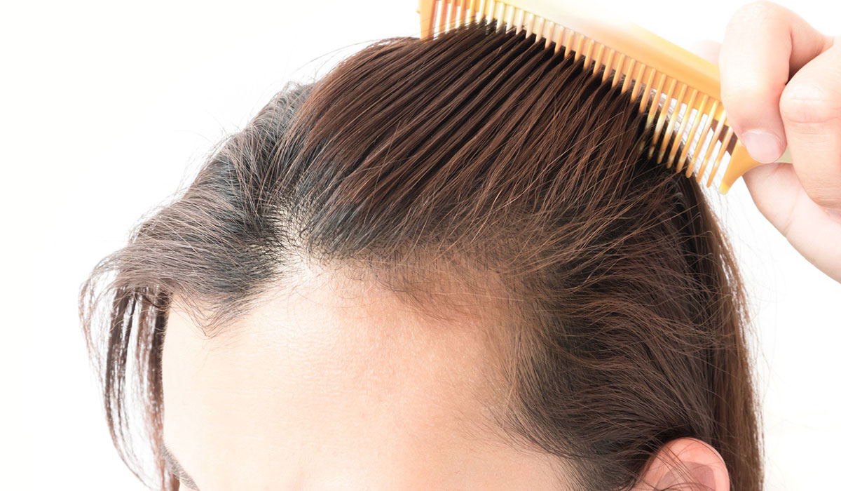 علاج تساقط الشعر للنساء .. كيفية التخلص منه بطرق مختلفة