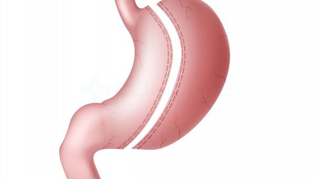 هل عملية التكميم خطيره