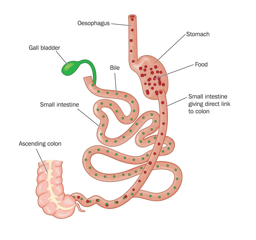 duodenal switch