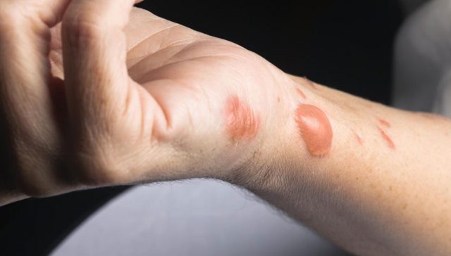 علاج اثار الحروق