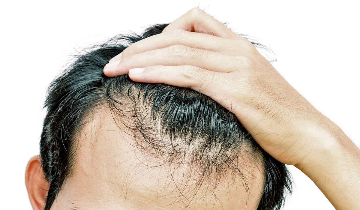 ادوية لعلاج تساقط الشعر للرجال والنساء وهل تعالج الفيتامينات