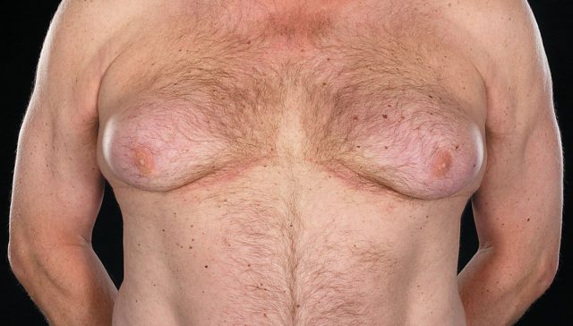 اعراض التثدي عند الرجال