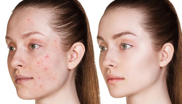 التخلص من حب الشباب