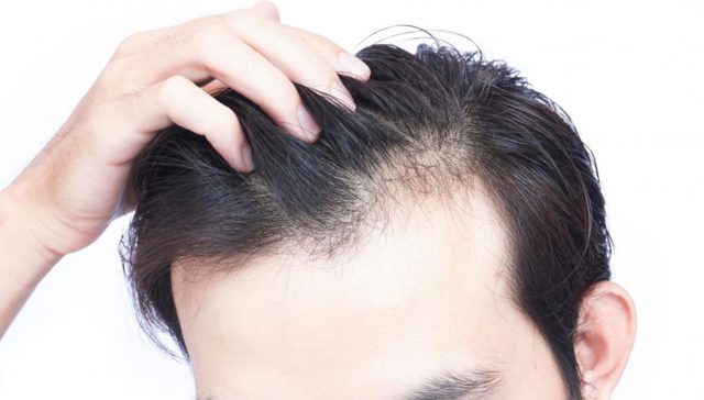 حقن البلازما بعد زراعة الشعر