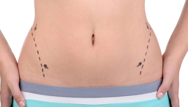 شفط الدهون بالتخدير الموضعي بتقنية Light Lipo