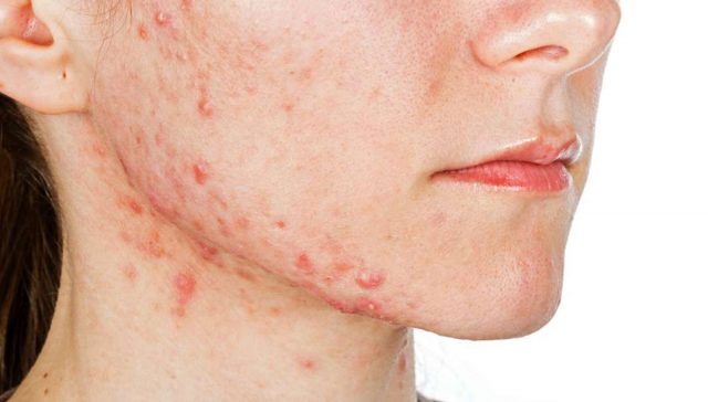 ظهور حبوب في الوجه اثناء الحمل.. وكيفية علاجها بطرق آمنة.. طبية ومنزلية 1 ظهور حبوب في الوجه اثناء الحمل