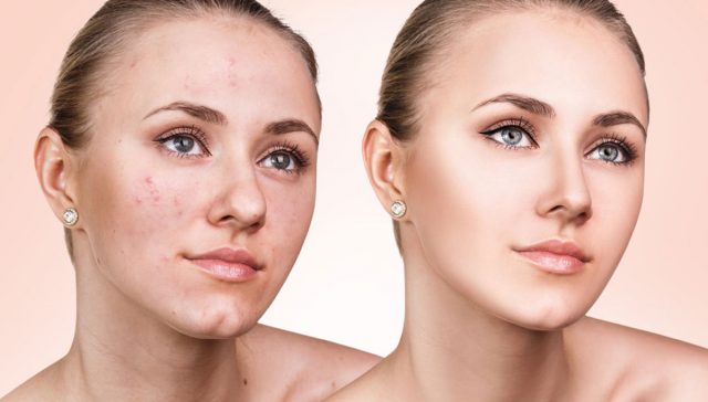 علاج حب الشباب