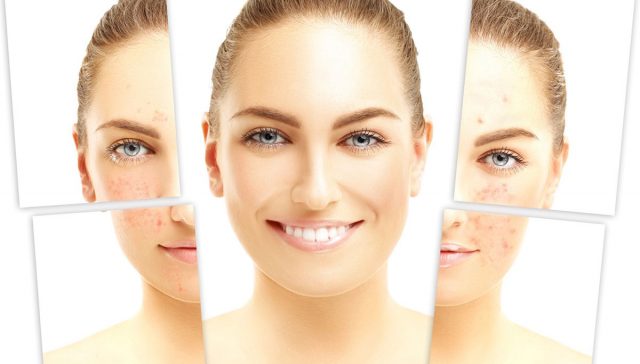 علاج حب الشباب للحامل