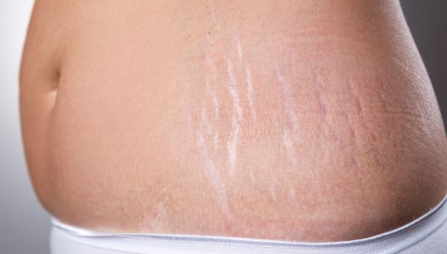 لازالة السيلوليت والخطوط البيضاء