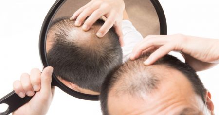 طرق علاج الصلع الوراثي.. لاستعادة كثافة الشعر بخيارات جراحية وغير جراحية