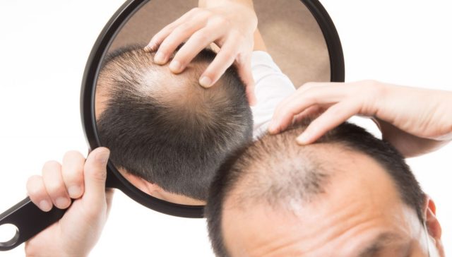 طرق علاج الصلع الوراثي.. لاستعادة كثافة الشعر بخيارات جراحية وغير جراحية 1 طرق علاج الصلع الوراثي