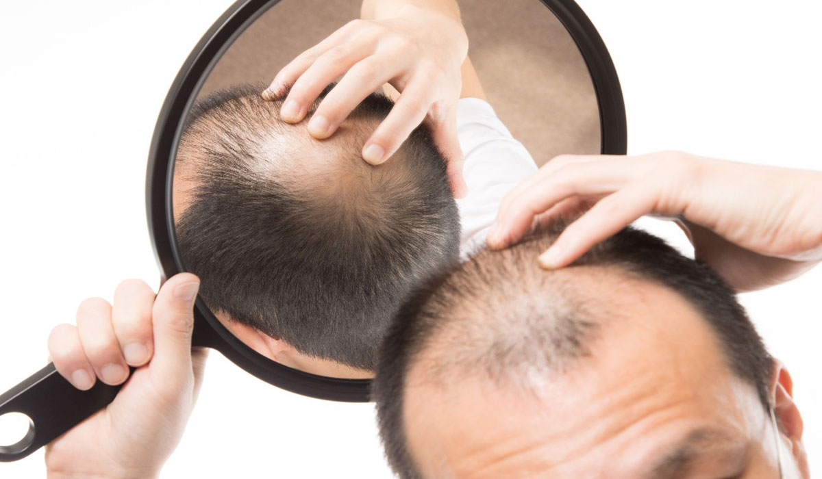 طرق علاج الصلع الوراثي.. لاستعادة كثافة الشعر بخيارات جراحية وغير جراحية