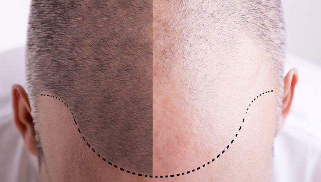 علاج صلع مقدمة الراس عند الرجال