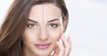 علاج ندبات الوجه.. خيارات عديدة والنتيجة بشرة أكثر صافية أكثر إشراقًا