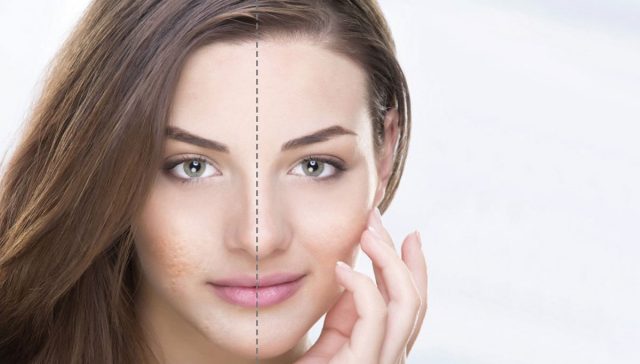 علاج ندبات الوجه