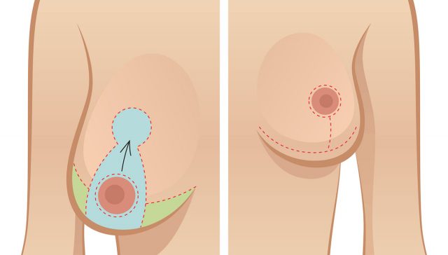 تصغير وشد الصدر