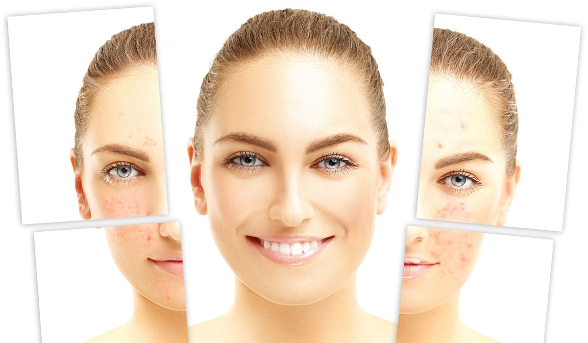 علاج الندبات في الوجه.. بطرق طبيعية وطبية.. لبشرة نقية وأكثر نضارة