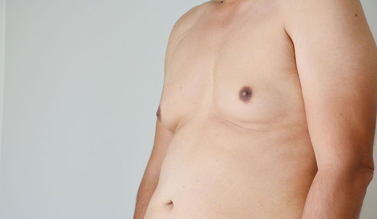 بروز الصدر عند الرجال.. الأسباب والتشخيص وطرق العلاج