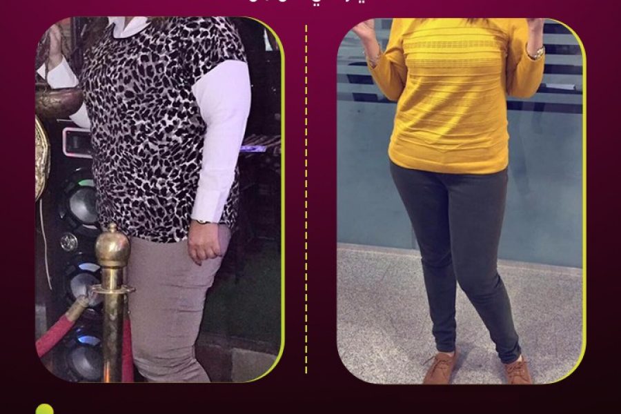 كبسولة بالون المعدة.. طريقك نحو الرشاقة بدون اللجوء للجراحة 4 كبسولة بالون المعدة