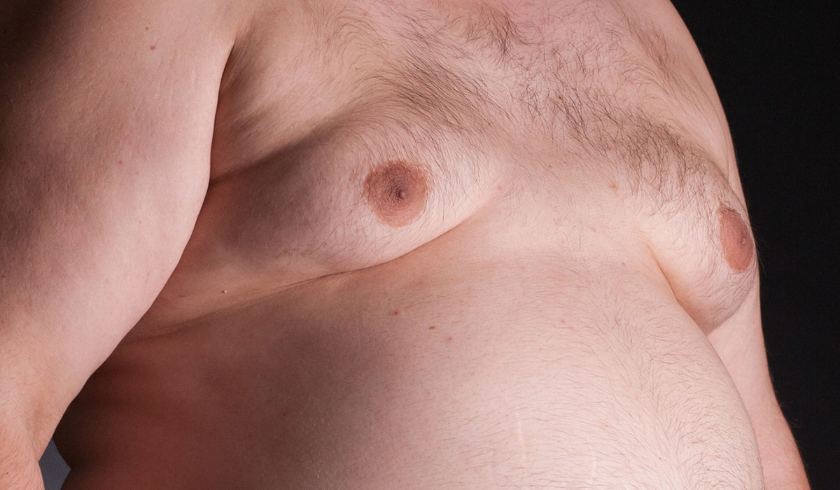 جراحة التثدي عند الرجال.. للتخلص النهائي من مشكلة كبر حجم الصدر