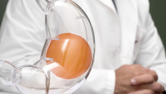 ازالة بالون المعدة