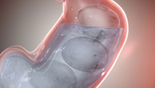 البالون في المعدة