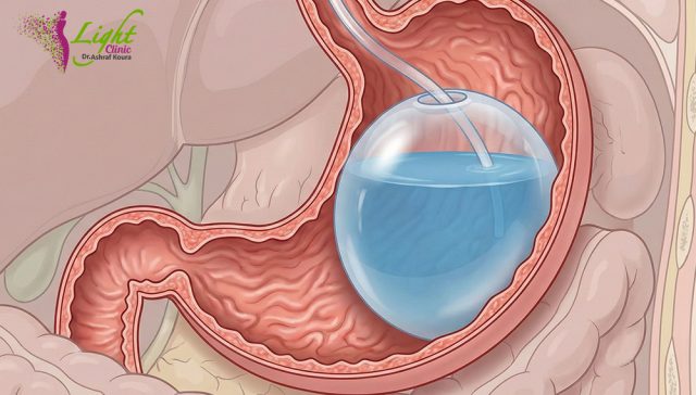 أشهر انواع بالون المعدة وأفضل نوع بالون معدة