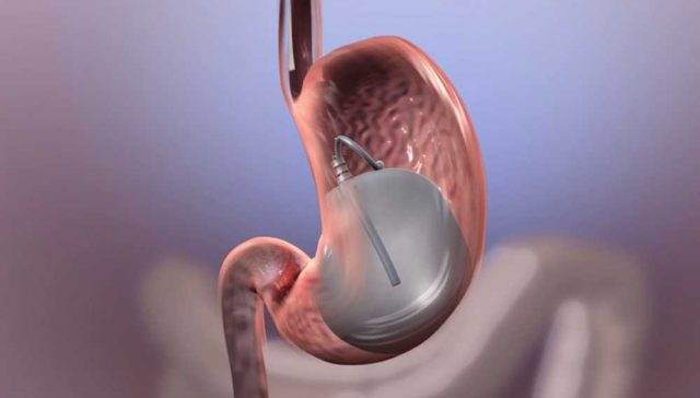 إزالة بالون المعدة