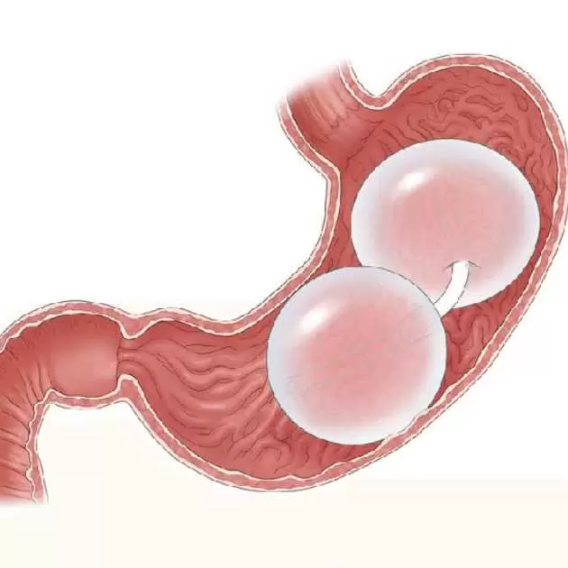 معلومات عن بالون المعدة