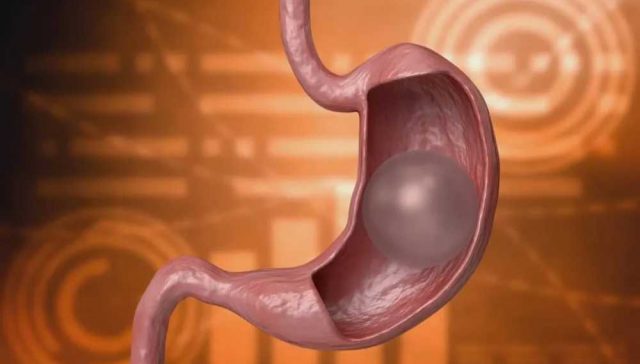 ما هو بالون المعدة