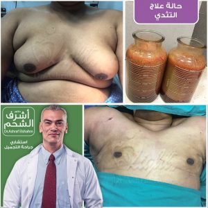 علاج التثدي