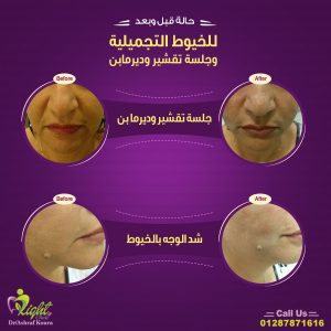 شد الوجه بالخيوط قبل وبعد