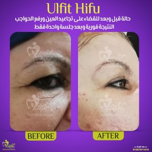 تجميل الوجه غير جراحي