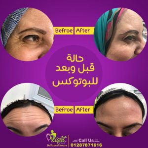 نتيجة حقن البوتوكس في علاج تجاعيد الجبهة