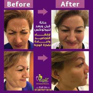 نتيجة حقن البوتوكس للتجاعيد
