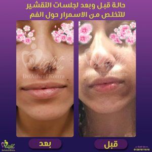 تجربة جلسات التقشير لعلاج الاسمرار حول الفم