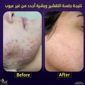 جلسة تقشير البشرة قبل وبعد