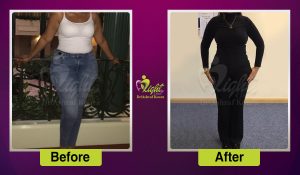 شفط الدهون 1 1