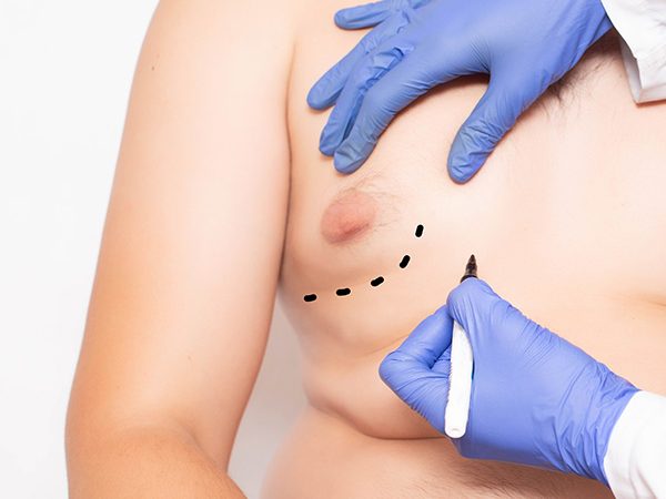 التثدي لدى الرجال