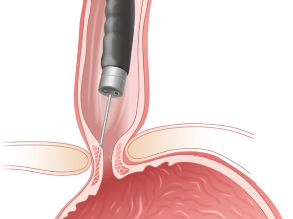 بوتكس المعدة