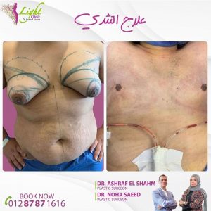 علاج التثدي