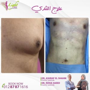 علاج التثدي