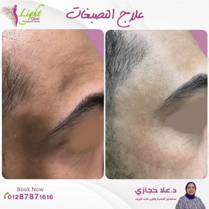 علاج التصبغات